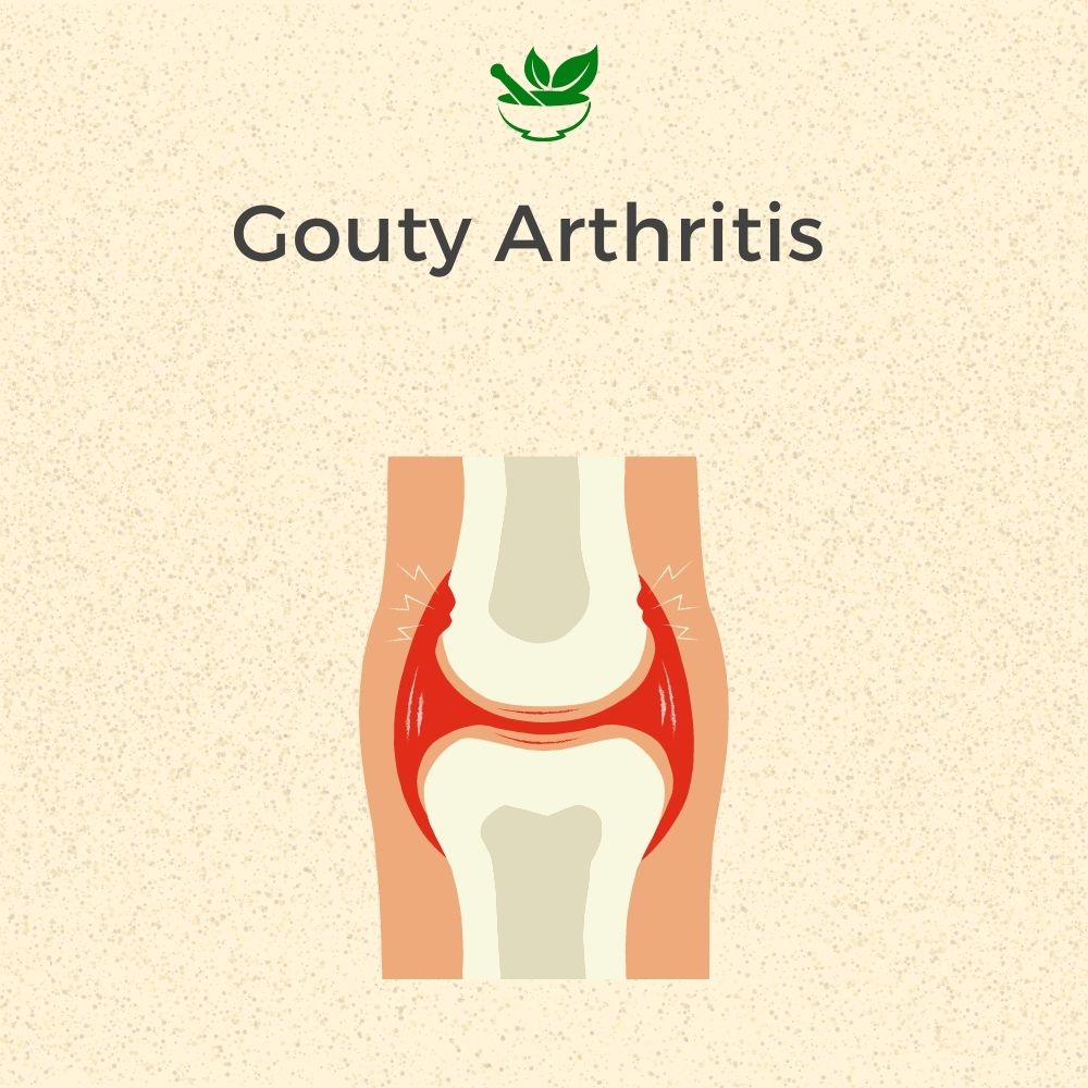 Deep Ayurveda Gouty Arthritis Ayurvedic Management 30 Days Pack