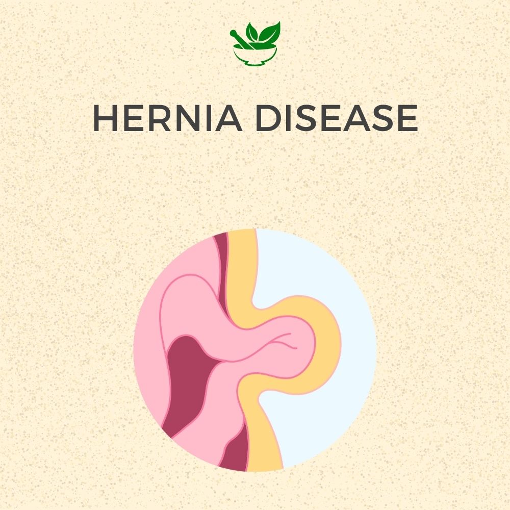 Deep Ayurveda Hernia Ayurvedic Management 30 Days Pack