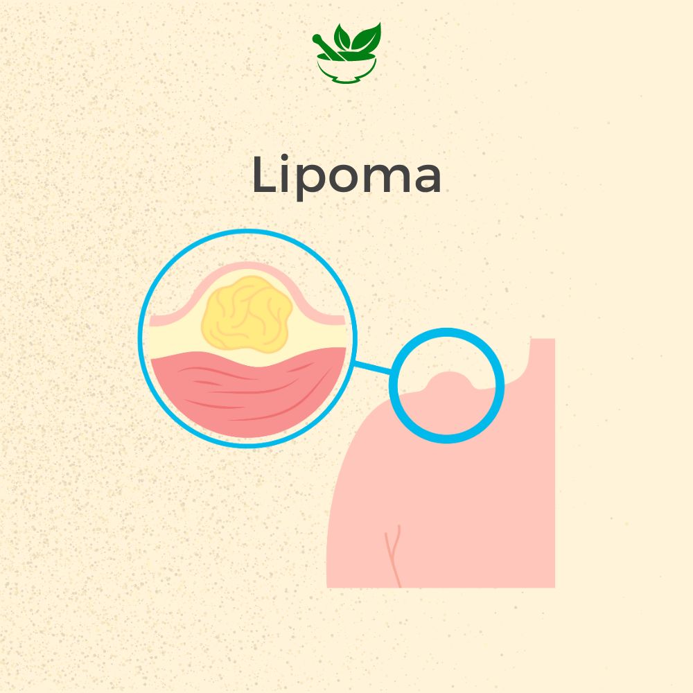 Deep Ayurveda Lipoma Ayurvedic Management 30 Days Pack