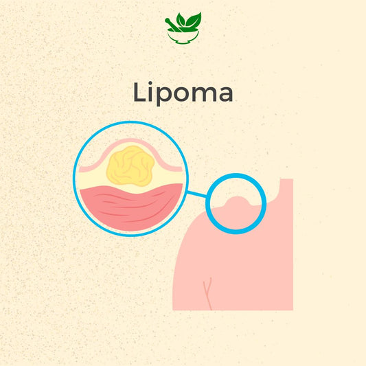 Deep Ayurveda Lipoma Ayurvedic Management 30 Days Pack